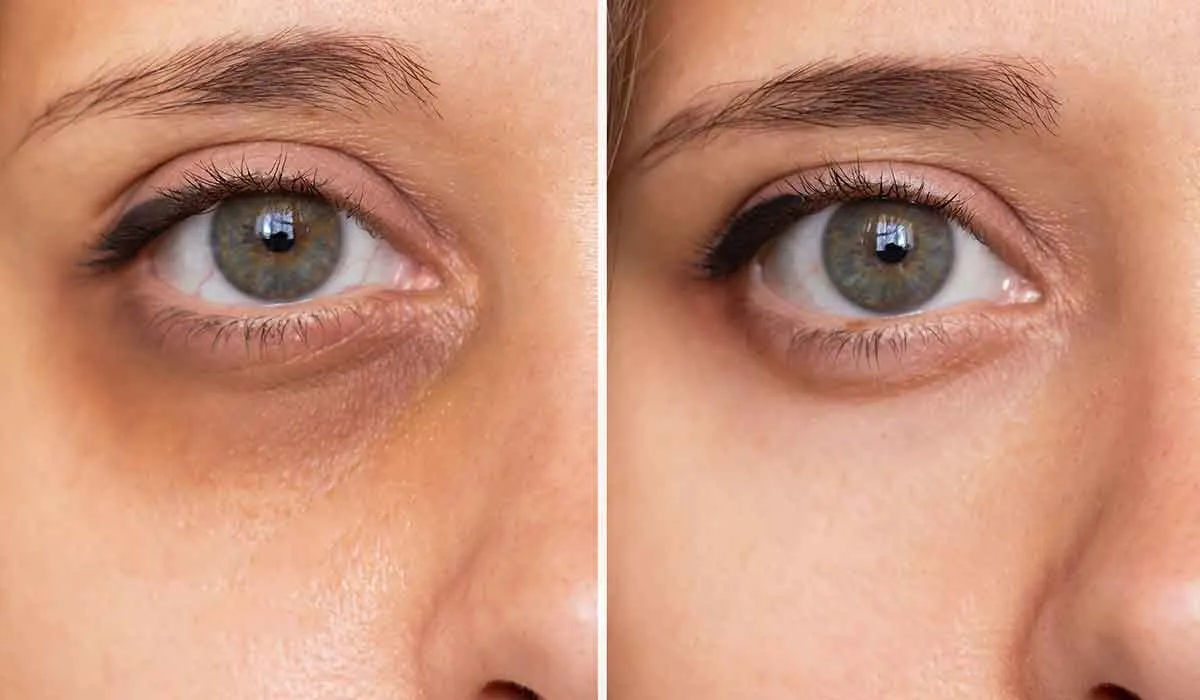 evita las ojeras, estas son las causas