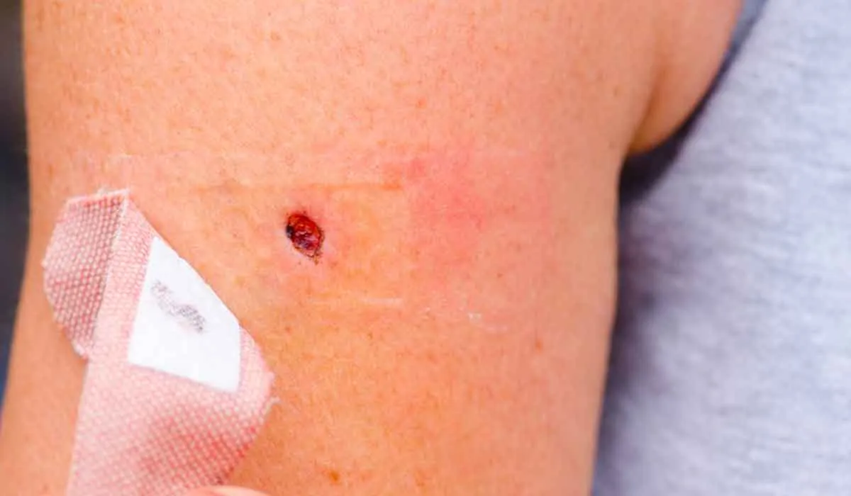 evita rascarte esa picazón por tu bien