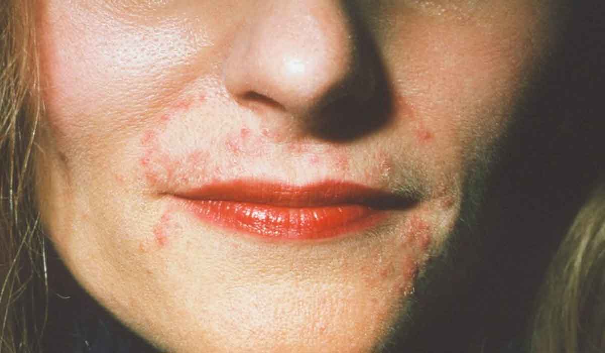 condiciones en la piel que pueden confundirse con acné