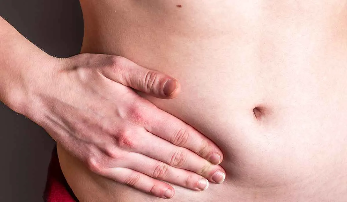 signos de que podrías tener una hernia