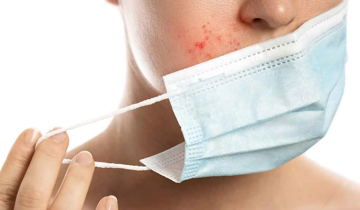 el acné puede aumentar por el uso del cubrebocas