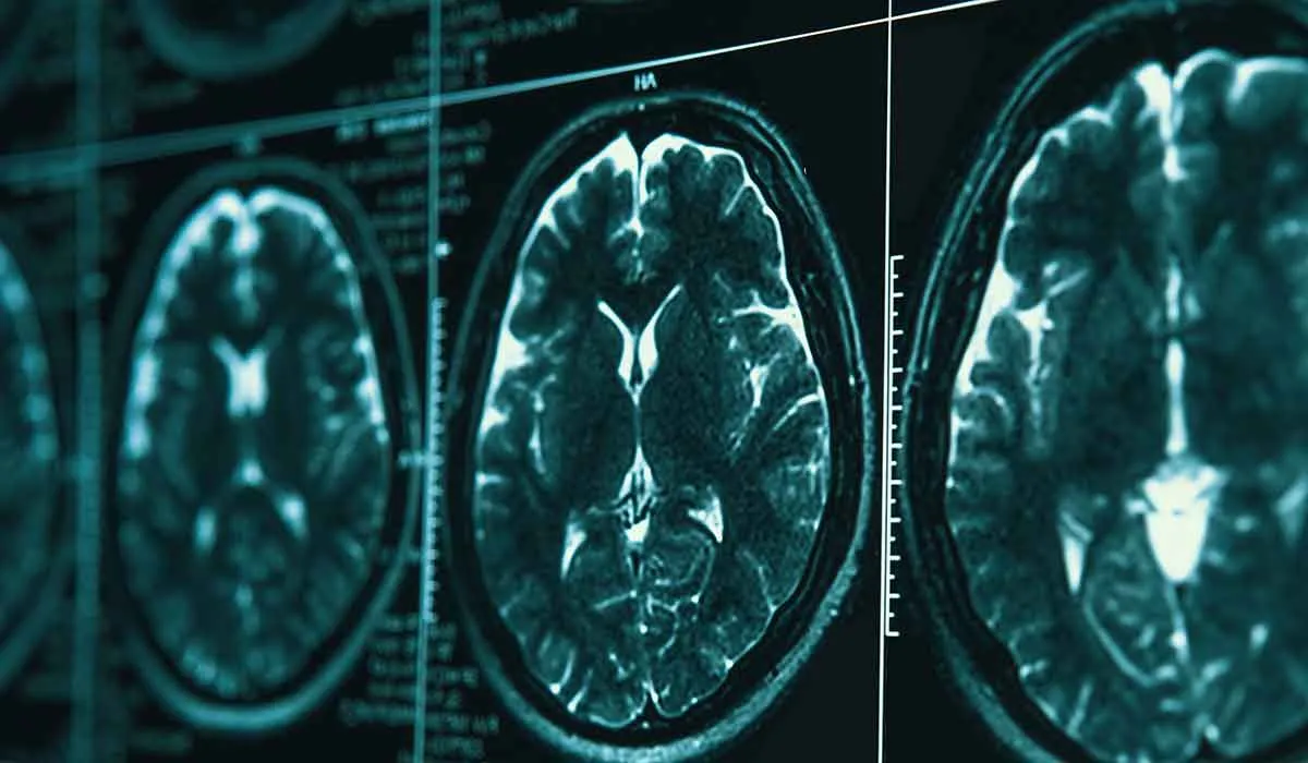 el cerebro cambia después de infectarse de covid
