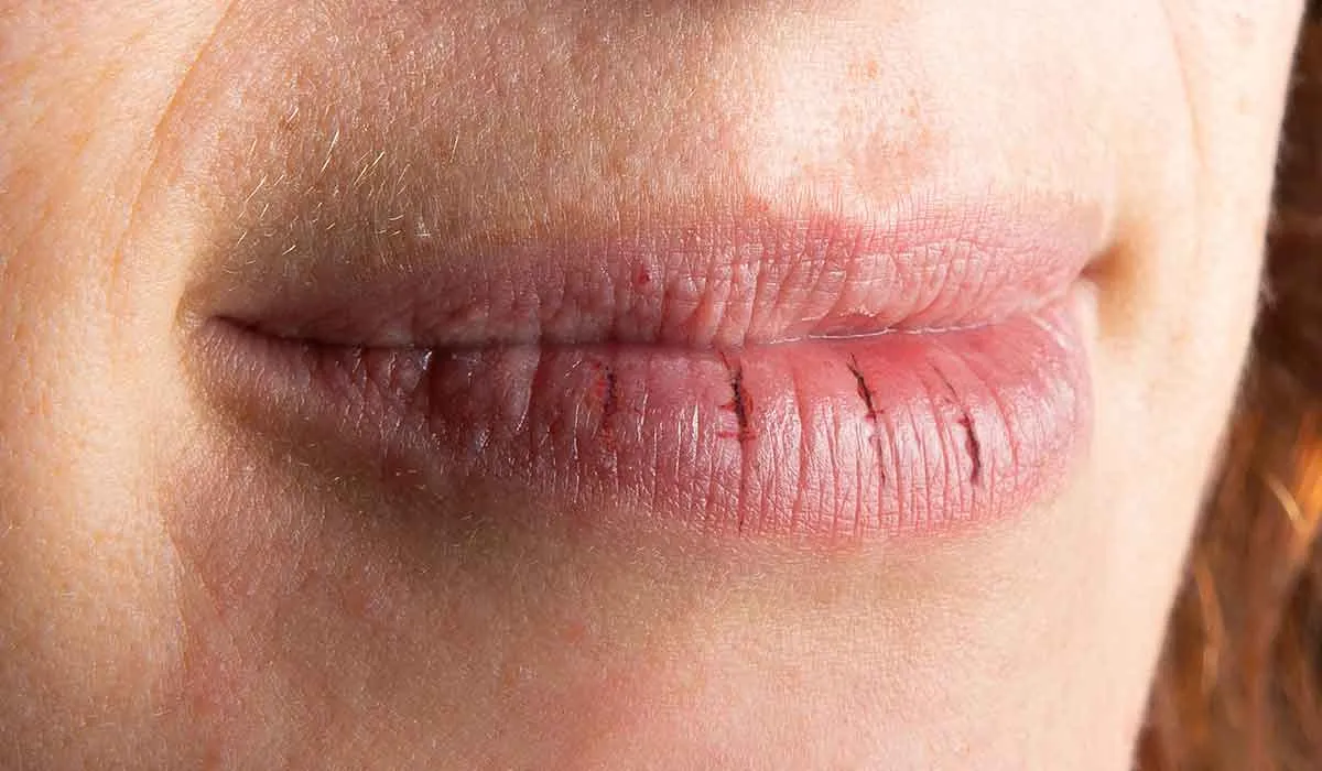 errores que provocan labios secos