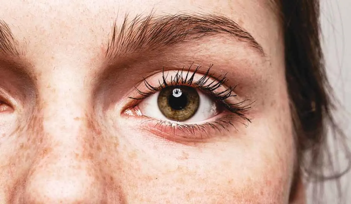 pecas en los ojos y su relación con tu salud
