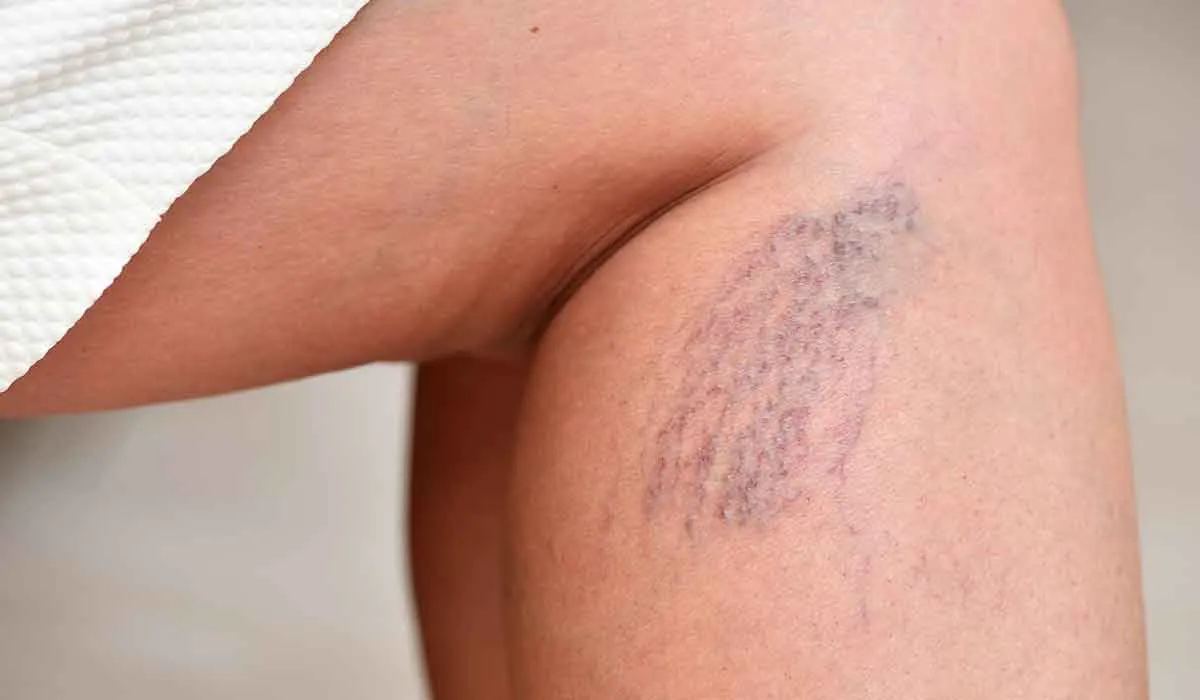 cosas que debes saber sobre las venas varicosas