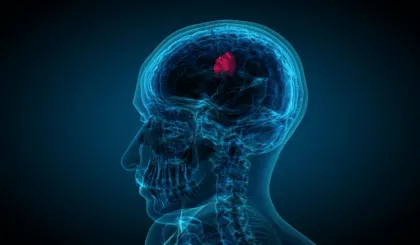 señales de que podrías tener un tumor cerebral