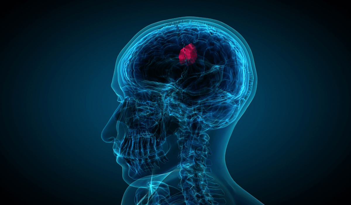 ¿Podría ser un tumor cerebral? Presta atención a estas señales de alerta