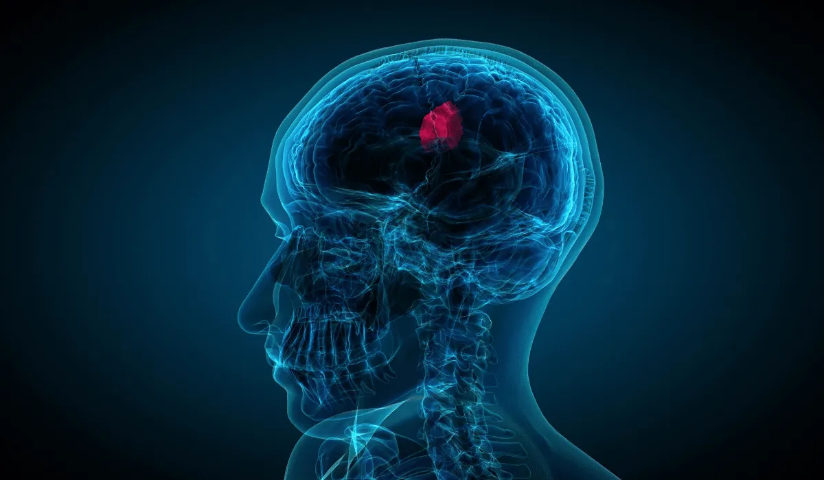señales de que podrías tener un tumor cerebral
