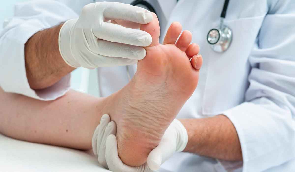 síntomas de hongos en los pies y cómo tratarlos