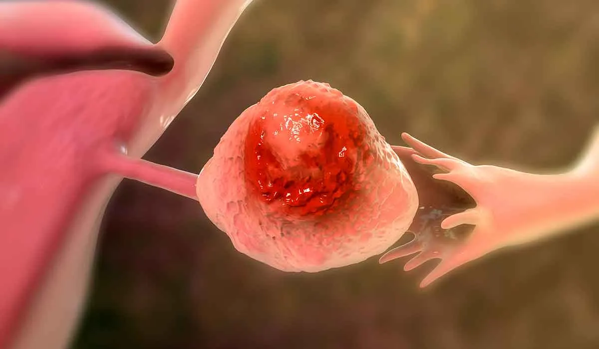 un grave signo de cáncer de ovario