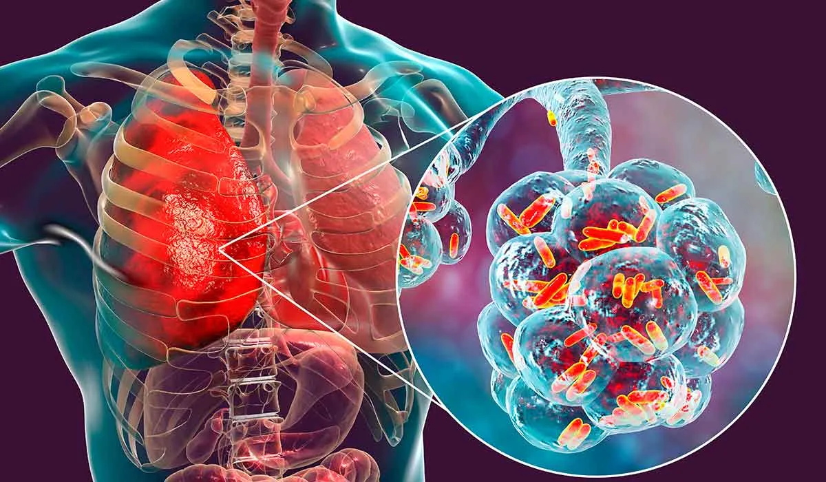 signos de que una infección respiratoria se convirtió en neumonía