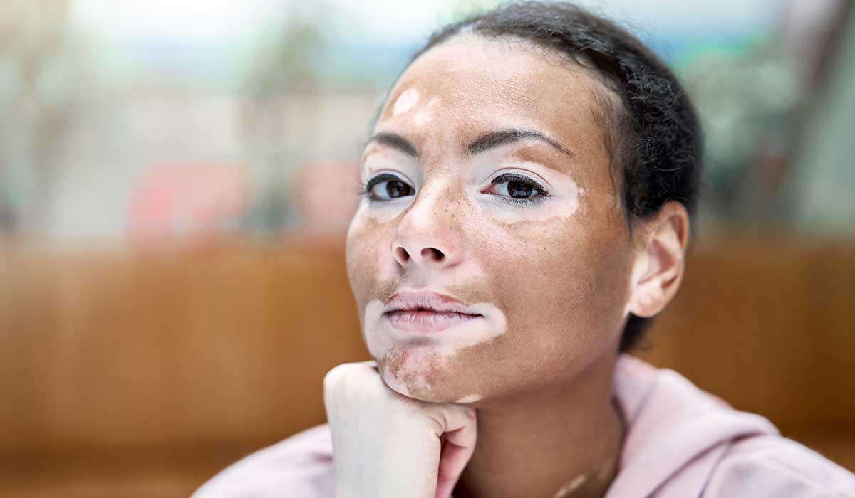 vitiligo una enfermdad que afecta las emociones