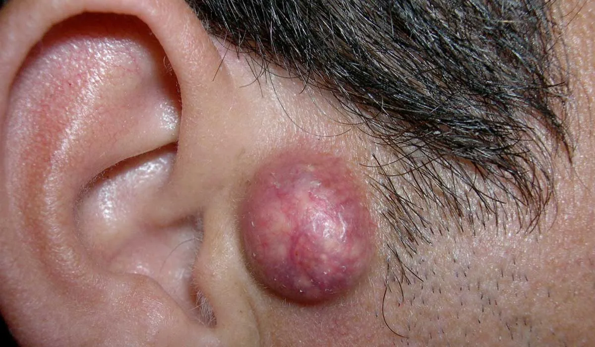 qué son los quistes epidermoides