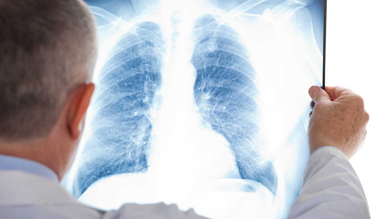 signos de que podrias tener una embolia pulmonar