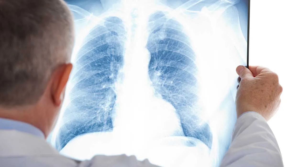 signos de que podrias tener una embolia pulmonar