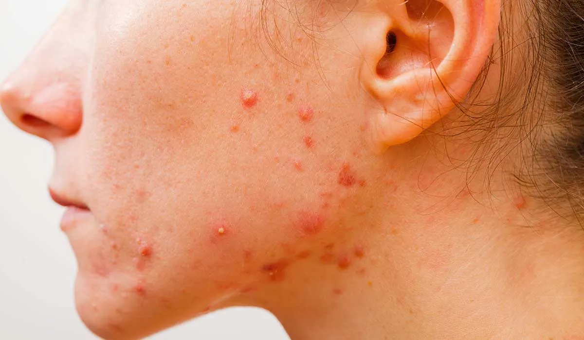 mitos sobre el acne en adultos
