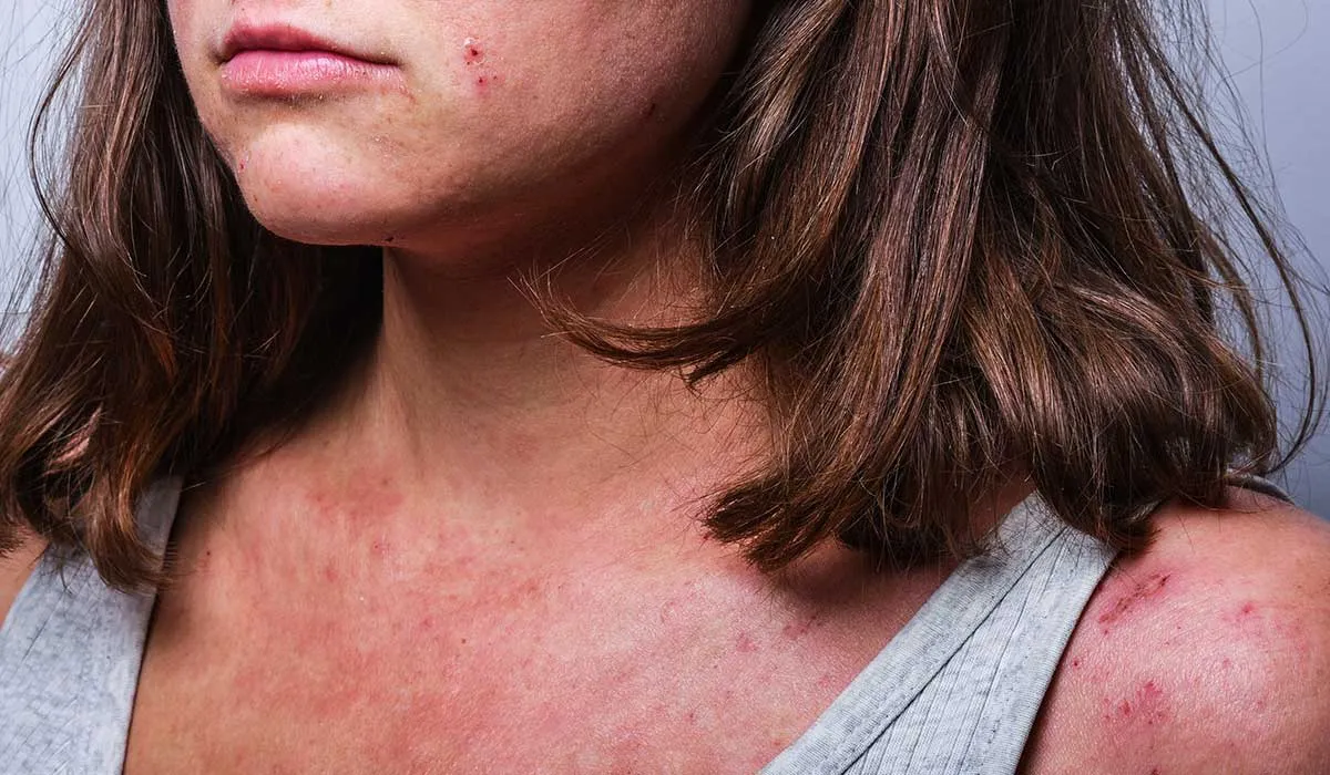 dermatitis atópica podría relacionarse con el suicidio