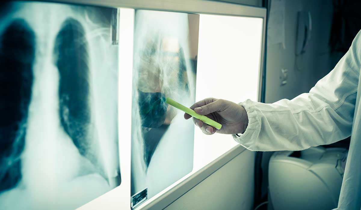 nuevas opciones contra el cáncer de pulmón
