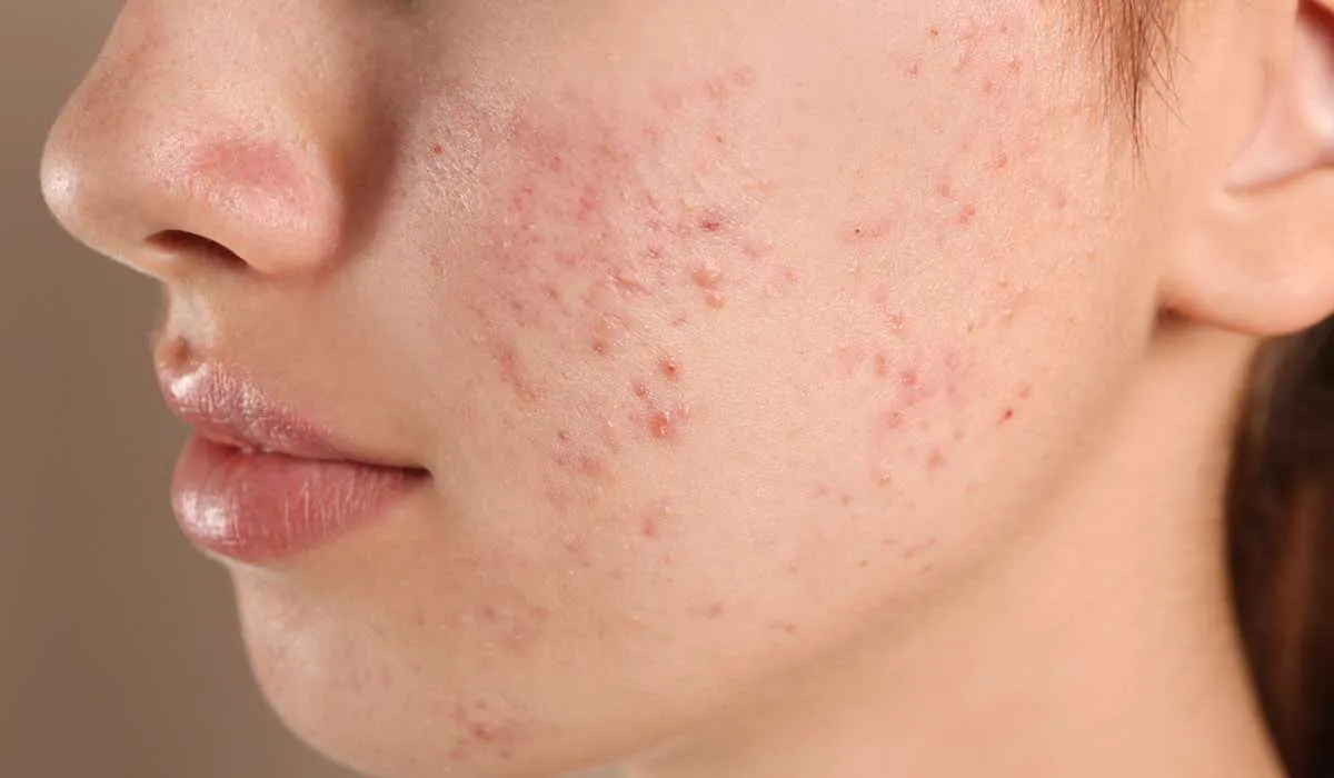 fagoterapia contra los problemas de acné