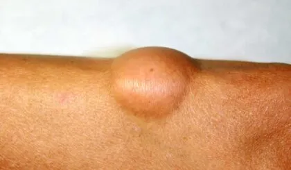 diferentes tipos de protuberancias en la piel y si son de cuidado