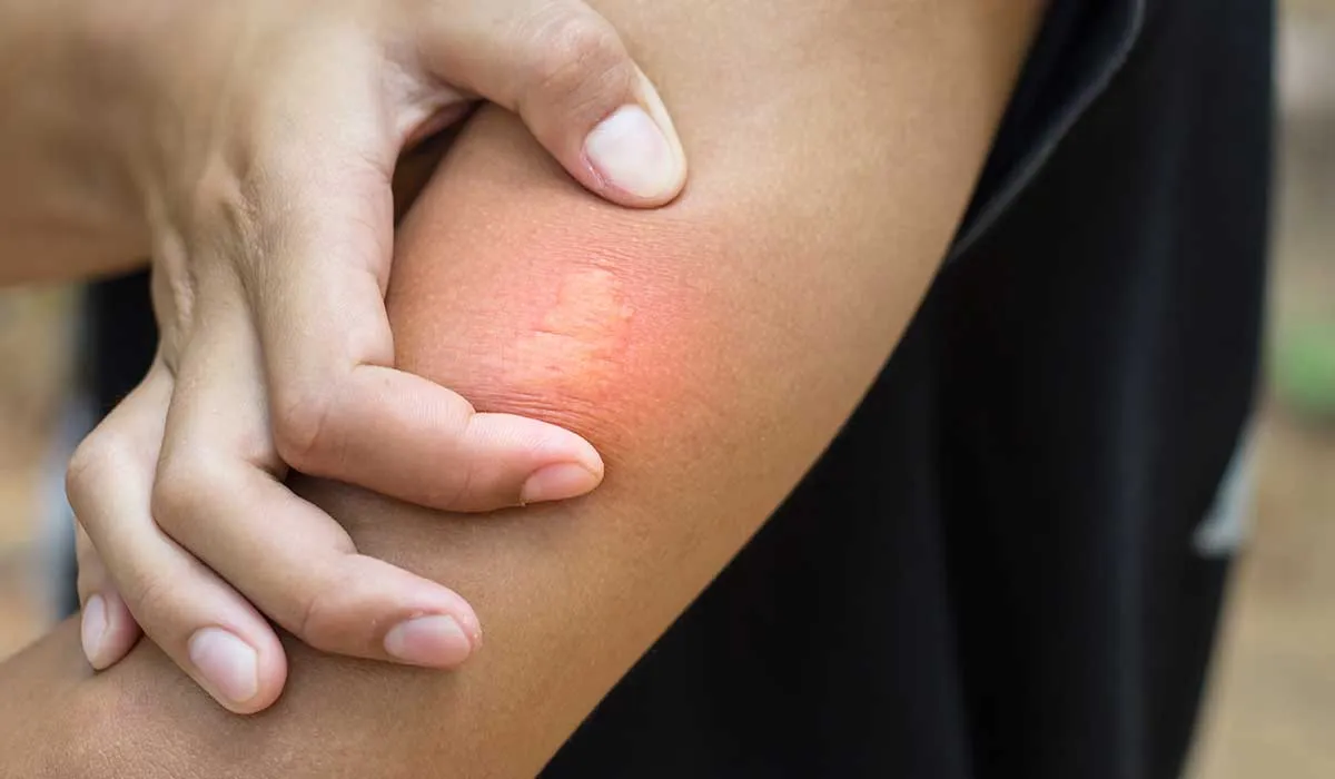 evita rascarte cuando te piquen los insectos