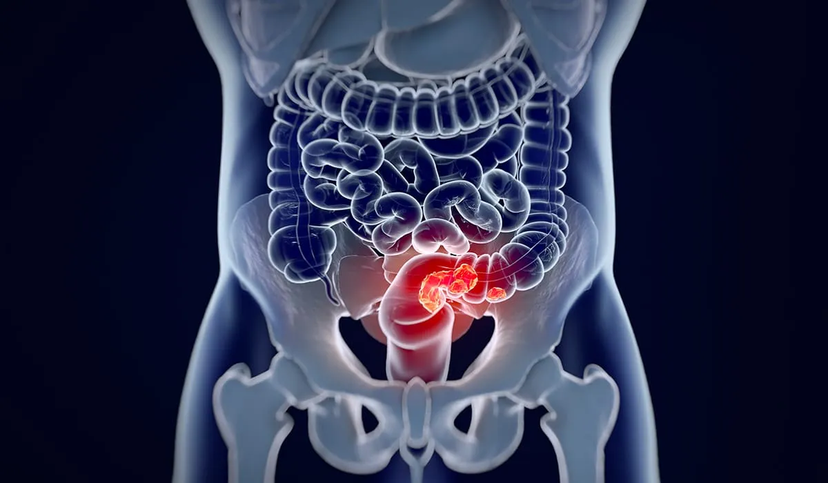 cáncer de colon