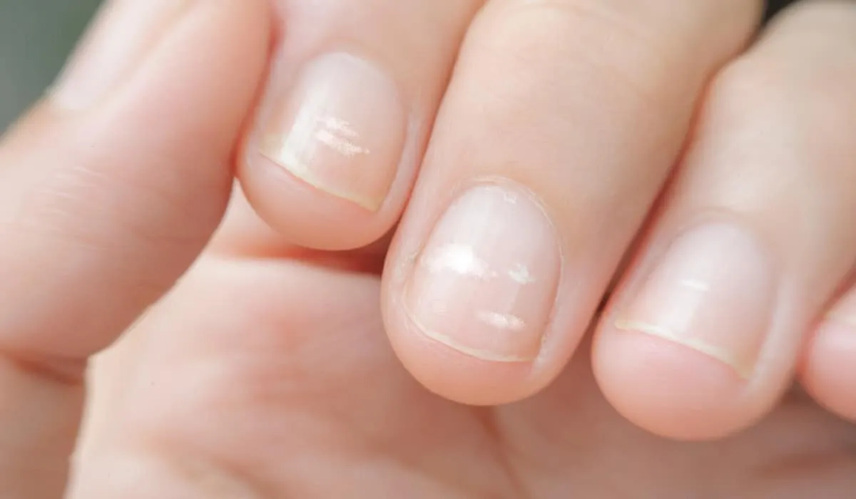 manchas blancas en las uñas