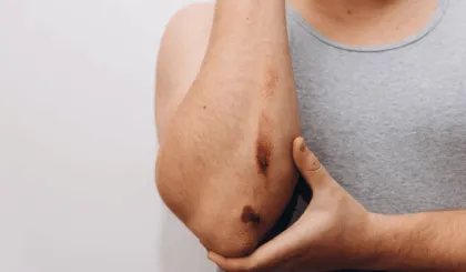 arrancarte las costras