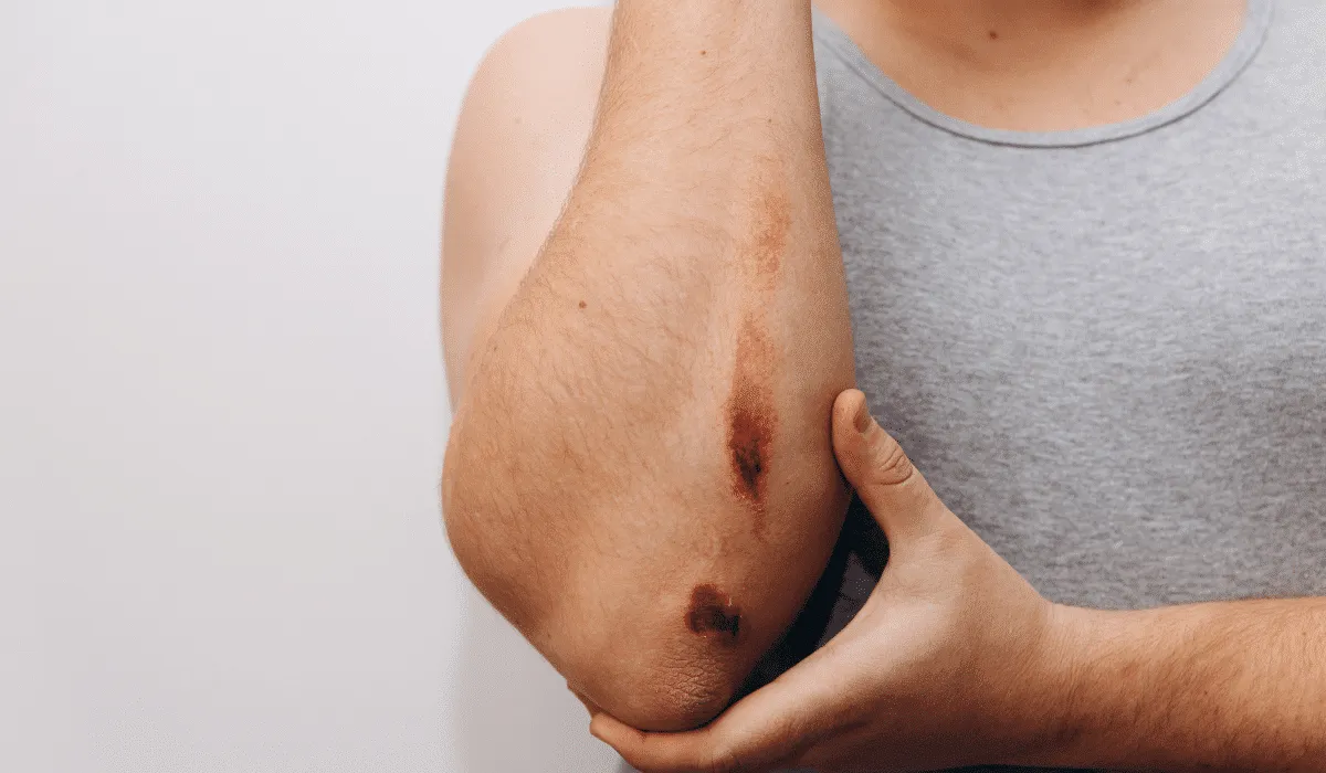 arrancarte las costras