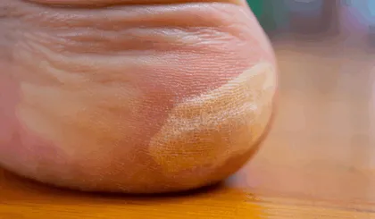 callos y callosidades