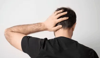 Deshazte de la caspa