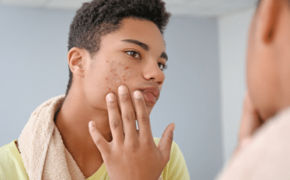 piel afectada por acné