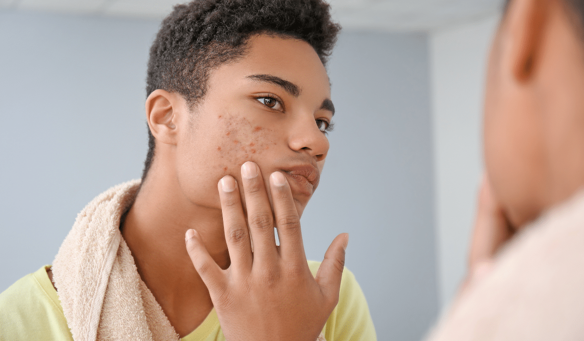 piel afectada por acné