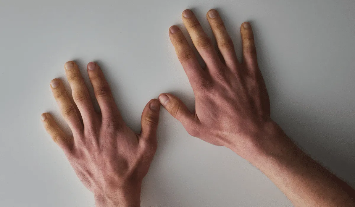 Esclerodermia