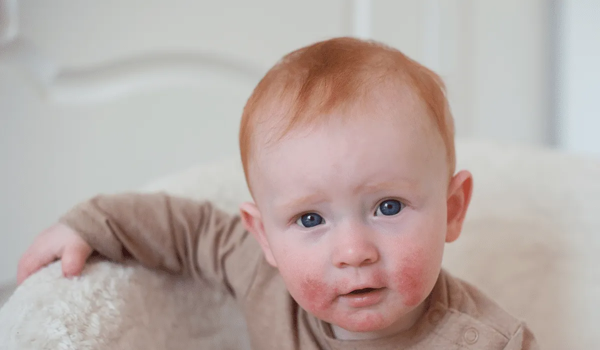 Dermatitis atópica