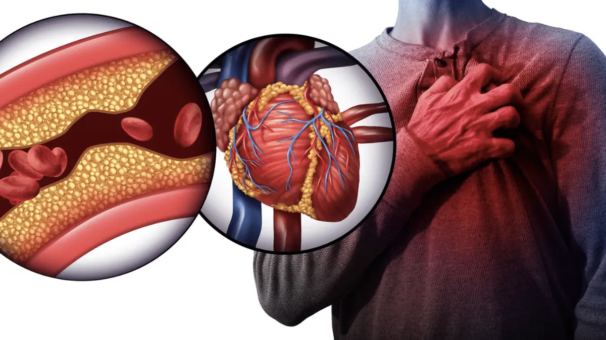 5 síntomas de arterias obstruidas