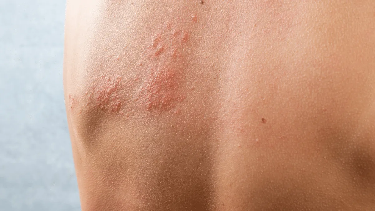 El estrés puede detonar herpes zóster