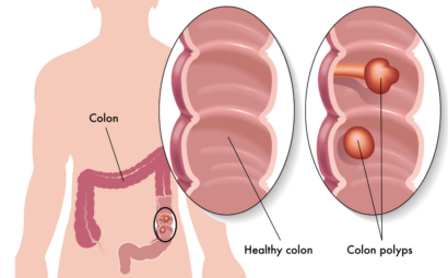 8 síntomas de pólipos de colon