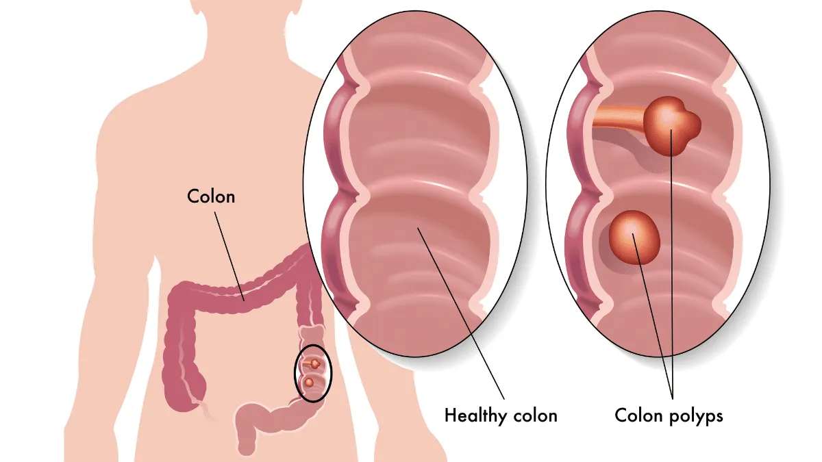 8 síntomas de pólipos de colon