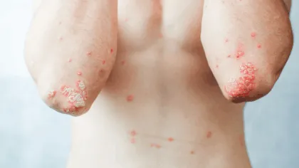 Psoriasis Pustulosa Generalizada