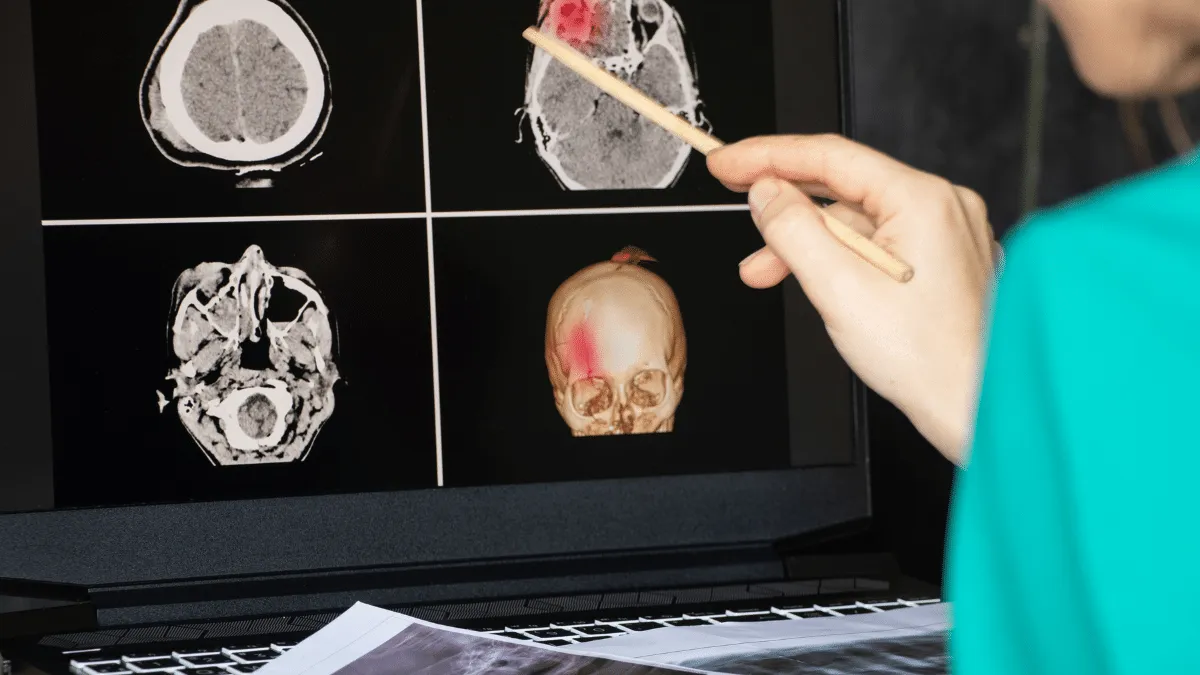 larvas de tenia en el cerebro