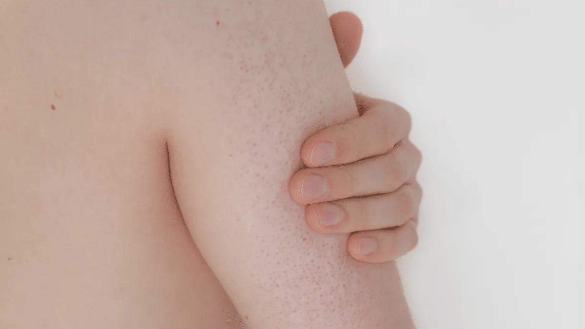 ¿Cómo combatir la piel de gallina ?