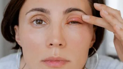 Orzuelo o chalazion Como diferenciarlos