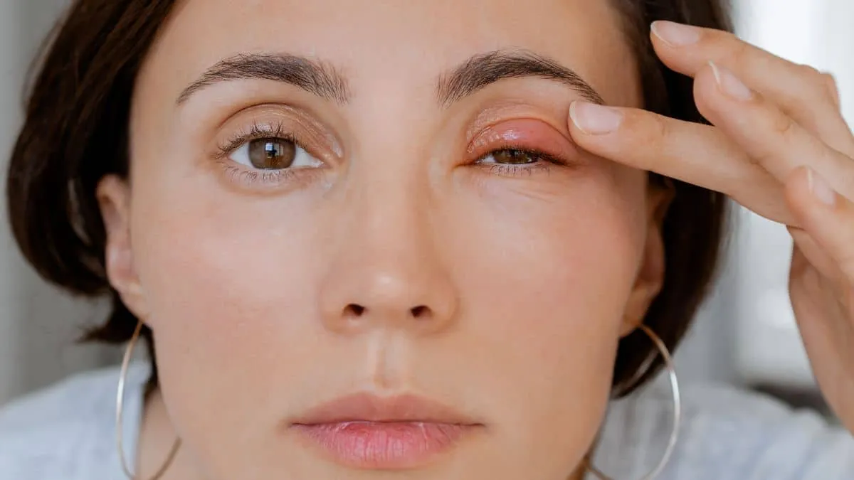 Orzuelo o chalazion Como diferenciarlos