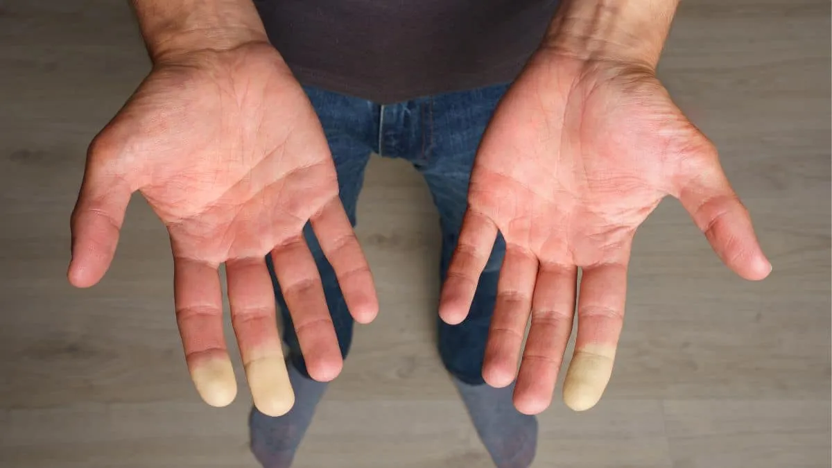 sindrome de Raynaud