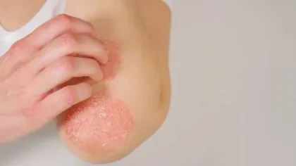 psoriasis