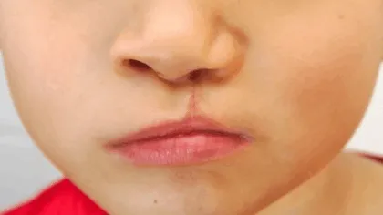 Labio y paladar hendido