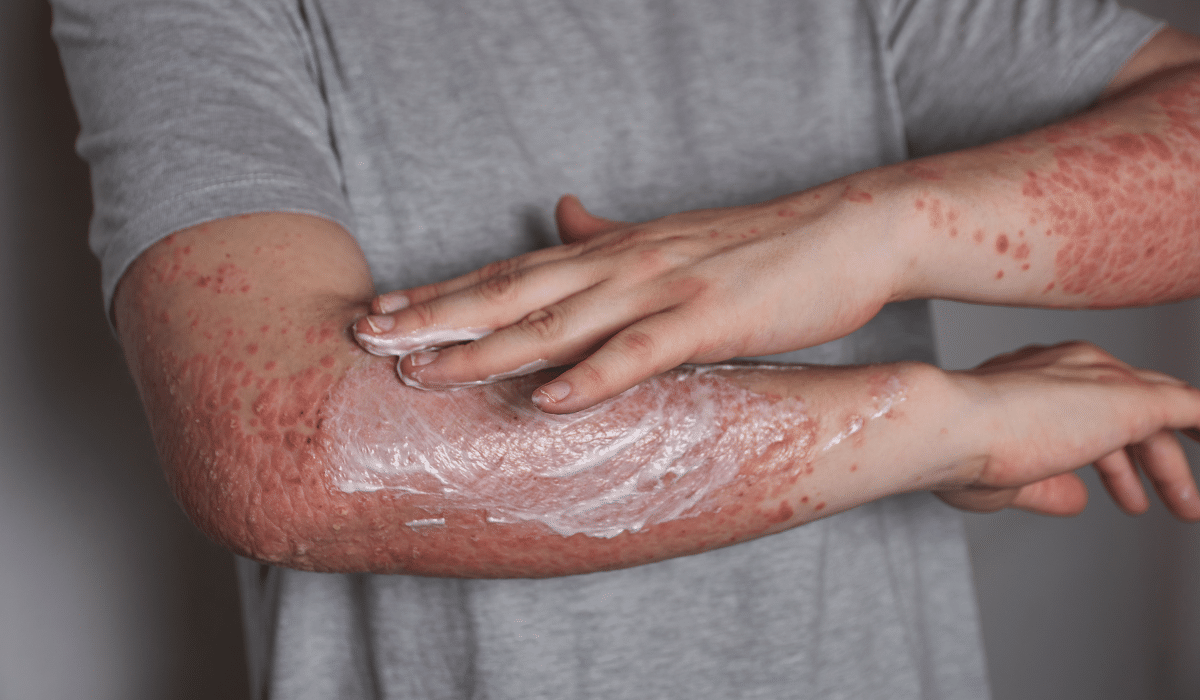 Incomprendidos y aislados, así viven quienes padecen psoriasis pustulosa generalizada