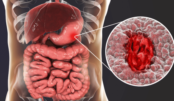 Cáncer gástrico, el sexto más común en México