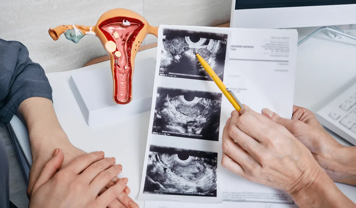 Descubre cómo la pérdida de peso puede mejorar los síntomas del síndrome de ovario poliquístico